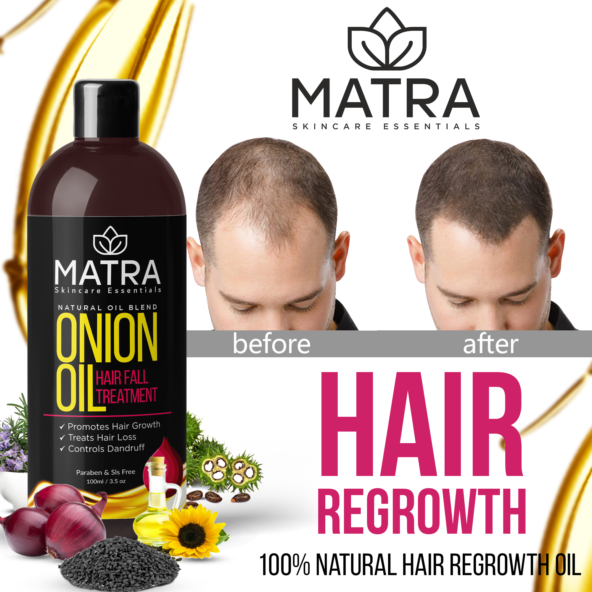 Buy Matra Onion Oil for hair Growth - Hair Fall - Dandruff Treatment